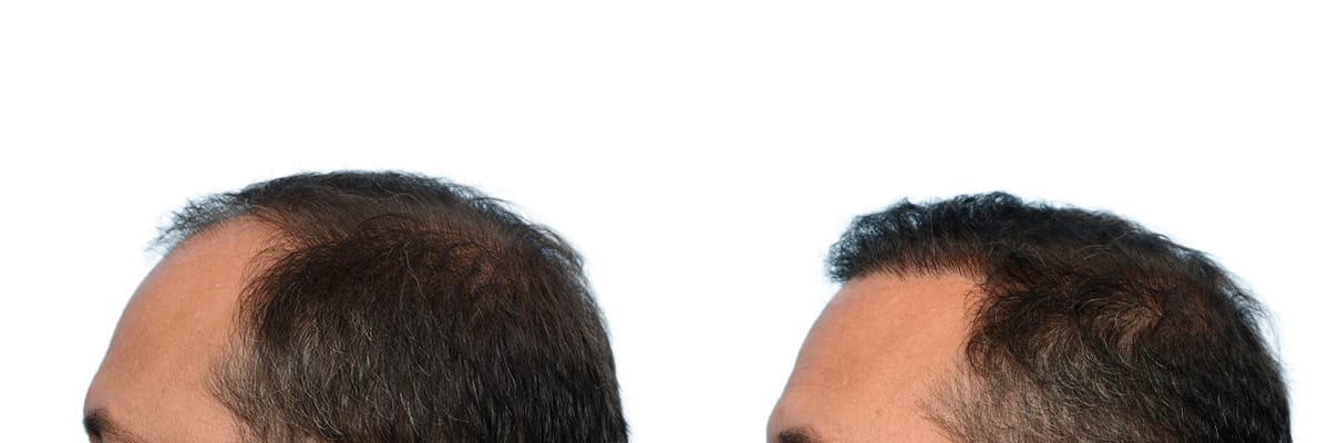 Hair Restoration  Before & After Gallery - Patient 304379 - Image 3