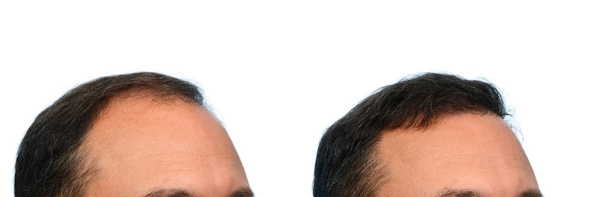 Hair Restoration  Before & After Gallery - Patient 304379 - Image 4