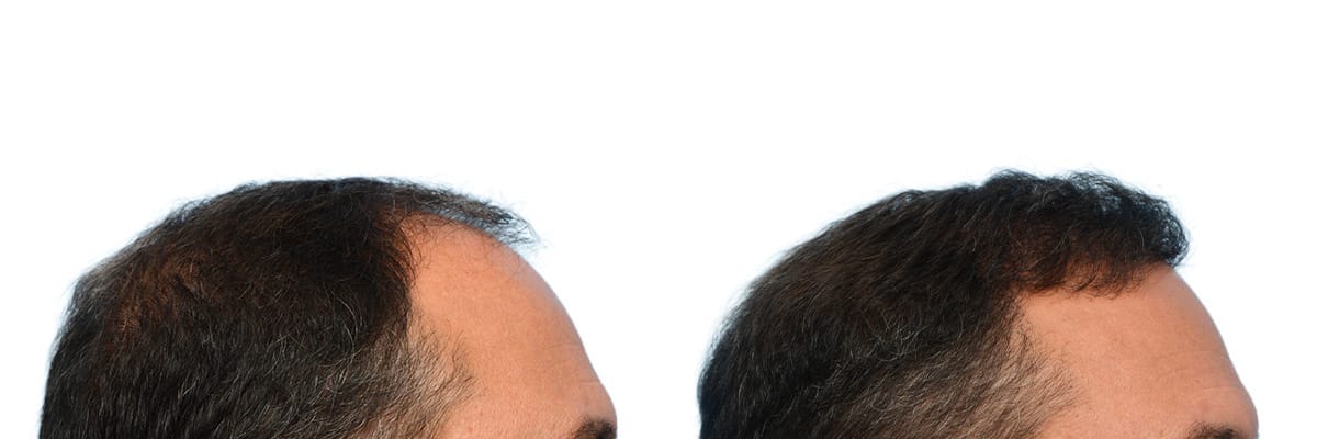 Hair Restoration  Before & After Gallery - Patient 304379 - Image 5