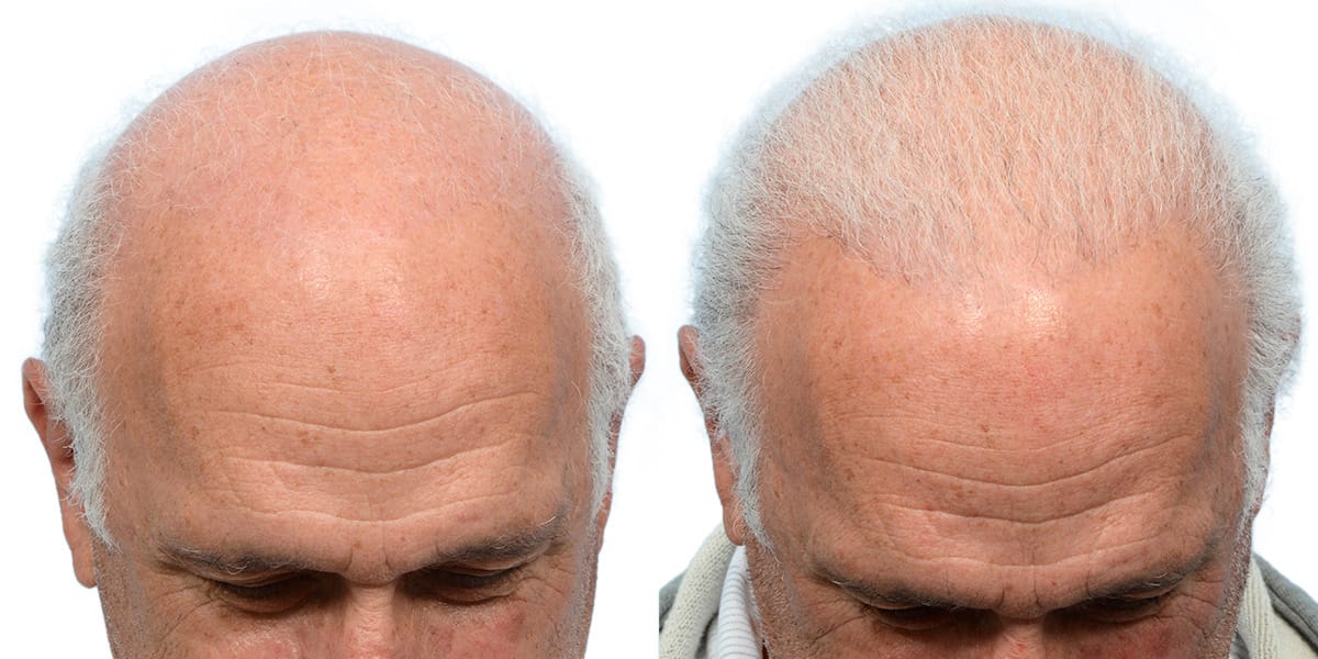 Hair Restoration  Before & After Gallery - Patient 930447 - Image 2