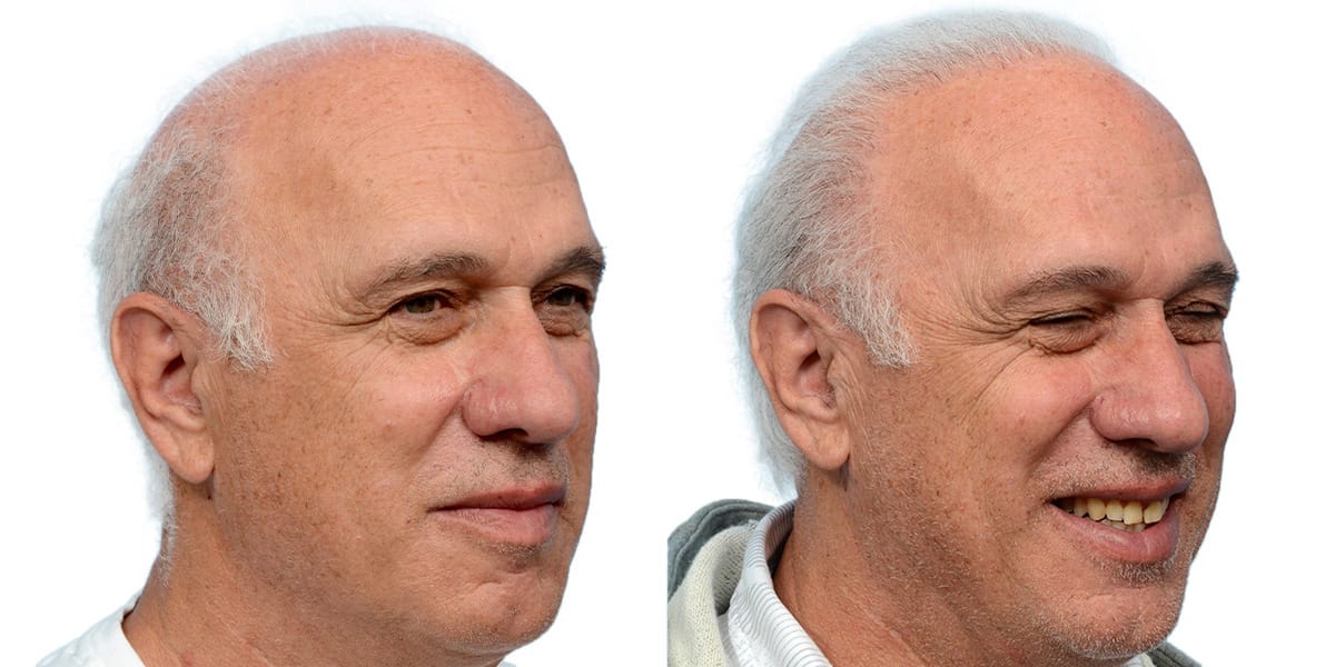 Hair Restoration  Before & After Gallery - Patient 930447 - Image 3