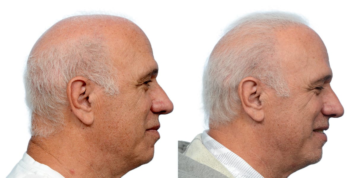 Hair Restoration  Before & After Gallery - Patient 930447 - Image 4