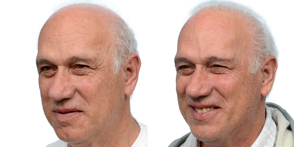 Hair Restoration  Before & After Gallery - Patient 930447 - Image 5