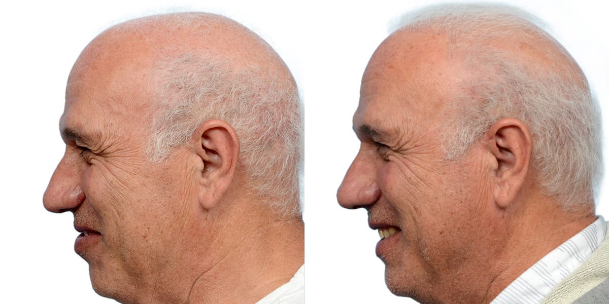 Hair Restoration  Before & After Gallery - Patient 930447 - Image 6