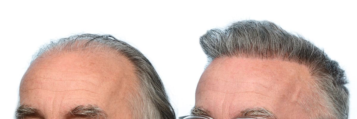 Hair Restoration  Before & After Gallery - Patient 248146 - Image 2