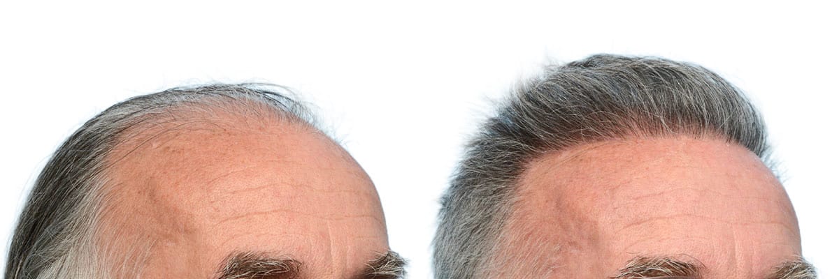 Hair Restoration  Before & After Gallery - Patient 248146 - Image 3