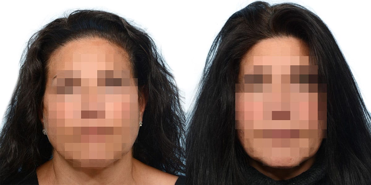 Female Hair Restoration Before & After Gallery - Patient 222930 - Image 1