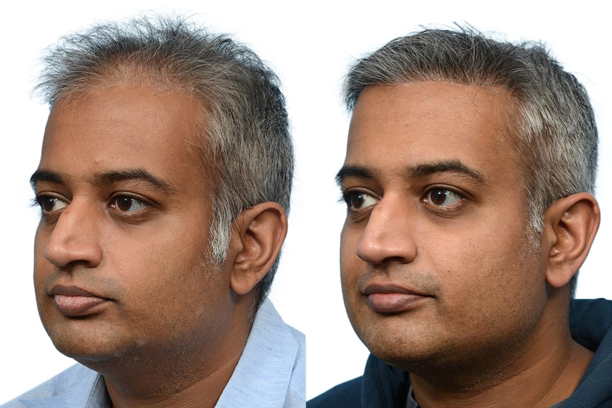 Hair Restoration  Before & After Gallery - Patient 124924 - Image 2
