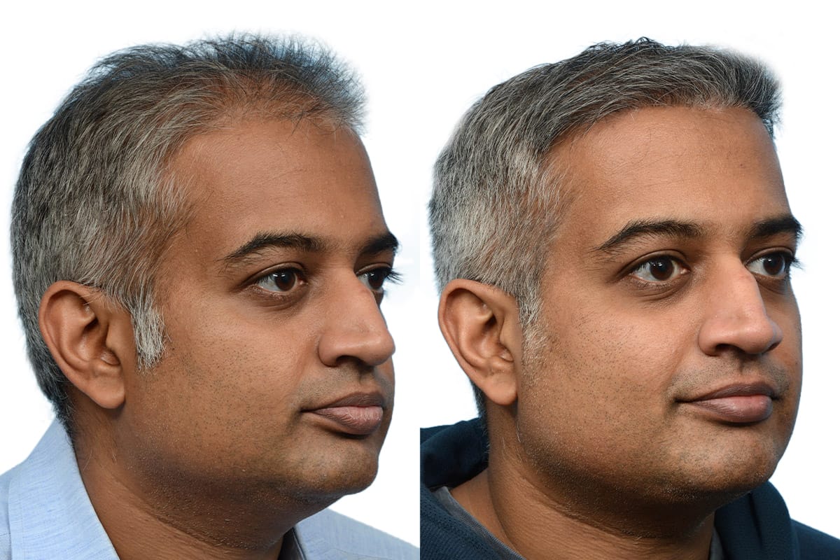 Hair Restoration  Before & After Gallery - Patient 124924 - Image 3