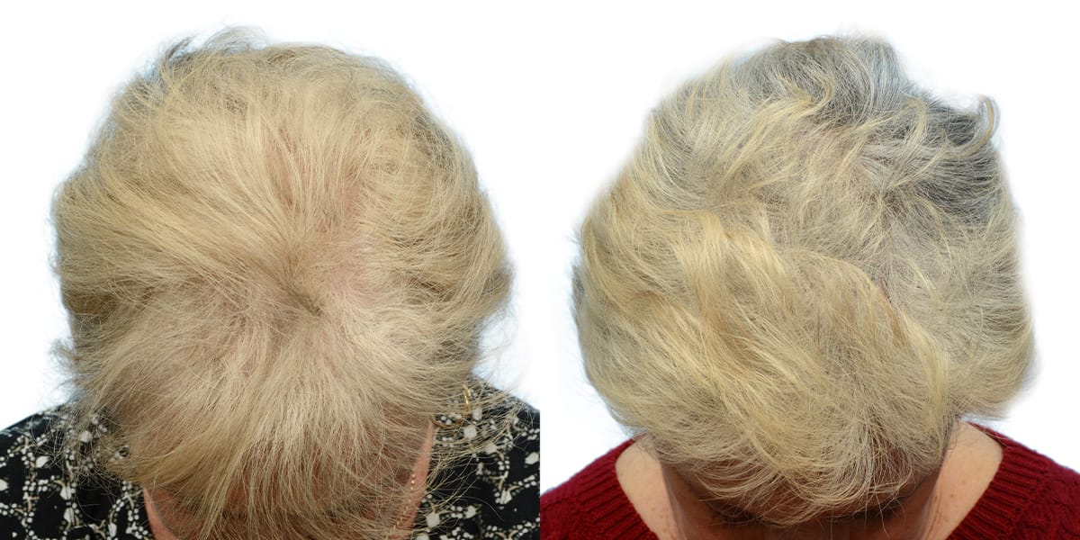 Platelet-Rich-Plasma Before & After Gallery - Patient 304946 - Image 2