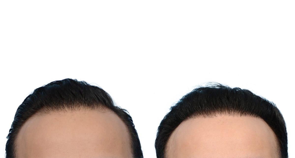Hair Restoration  Before & After Gallery - Patient 388464 - Image 2