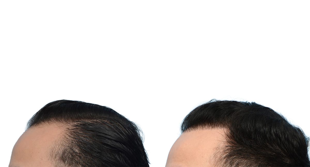 Hair Restoration  Before & After Gallery - Patient 388464 - Image 3