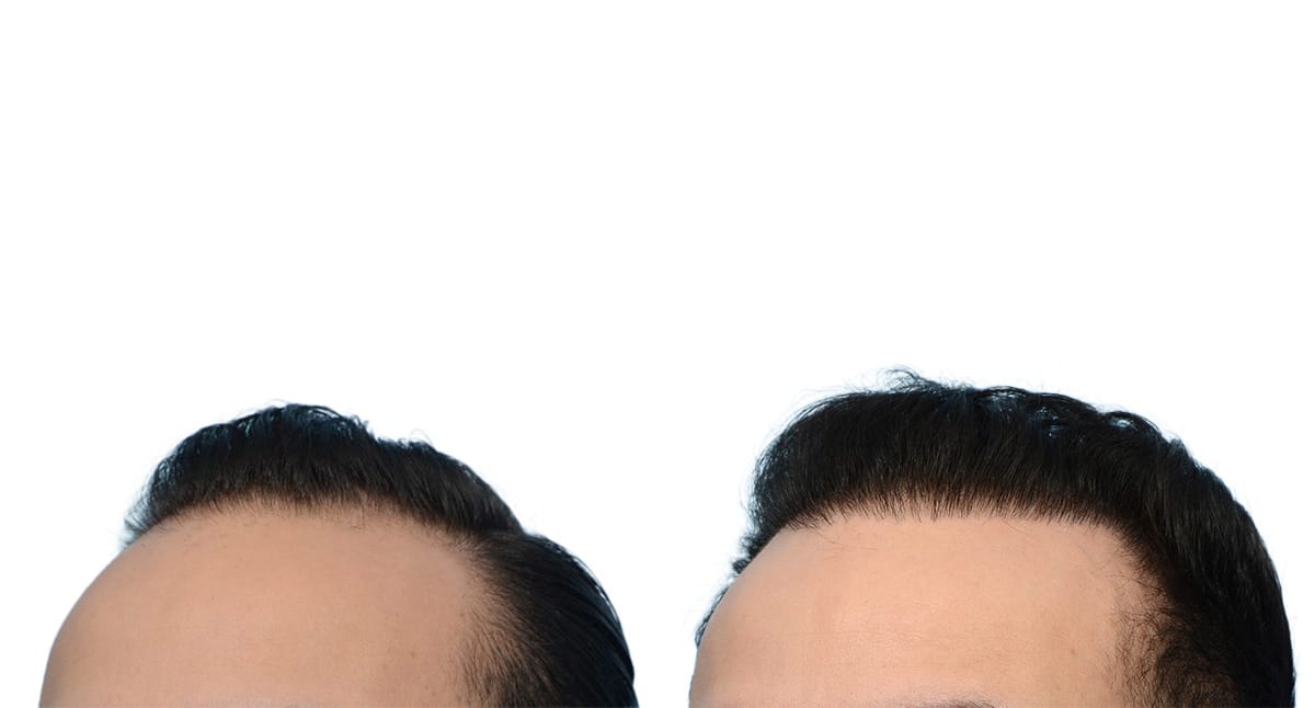 Hair Restoration  Before & After Gallery - Patient 388464 - Image 4