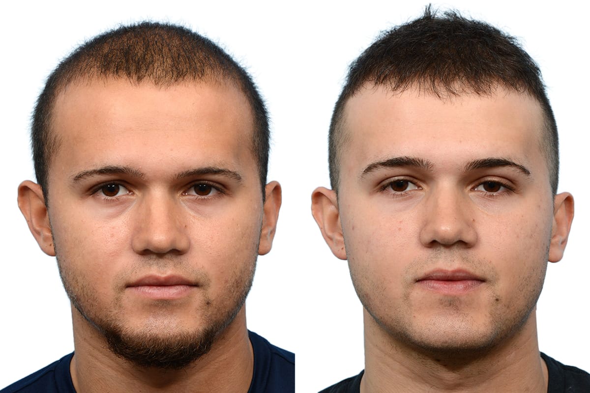 Hair Restoration  Before & After Gallery - Patient 587938 - Image 2