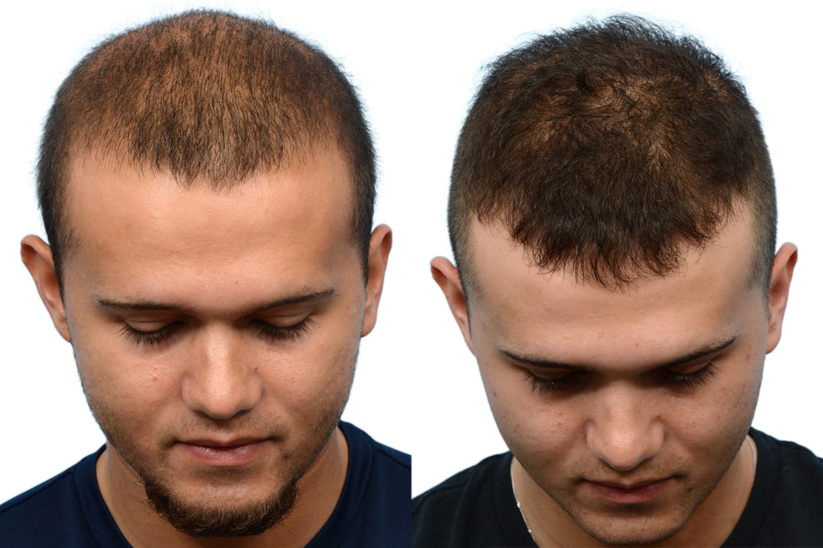 Hair Restoration  Before & After Gallery - Patient 587938 - Image 3