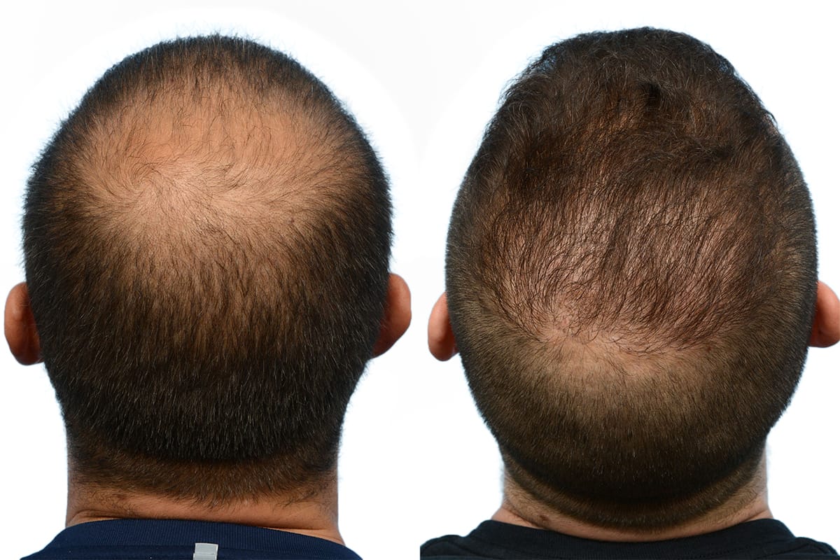Hair Restoration  Before & After Gallery - Patient 587938 - Image 1