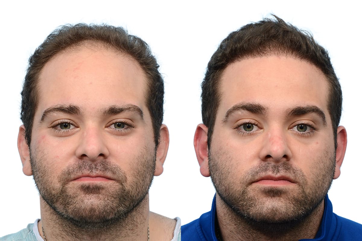 FUE Hair Transplant Before & After Gallery - Patient 143636 - Image 2