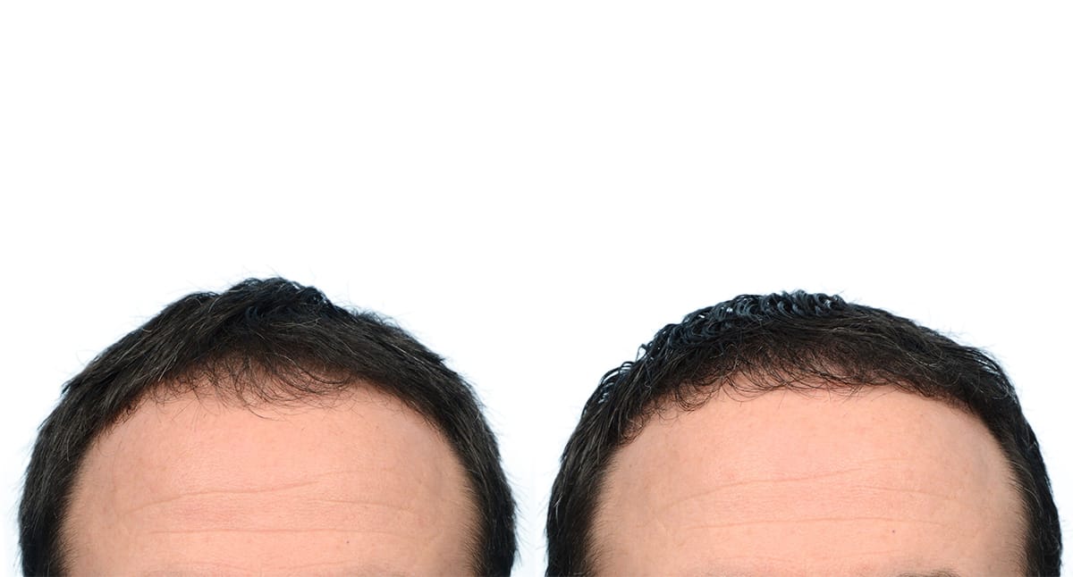 Hair Restoration  Before & After Gallery - Patient 145761 - Image 2