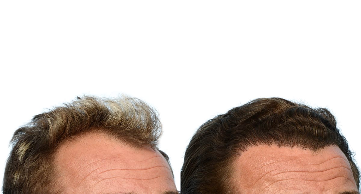 FUE Hair Transplant Before & After Gallery - Patient 525209 - Image 3