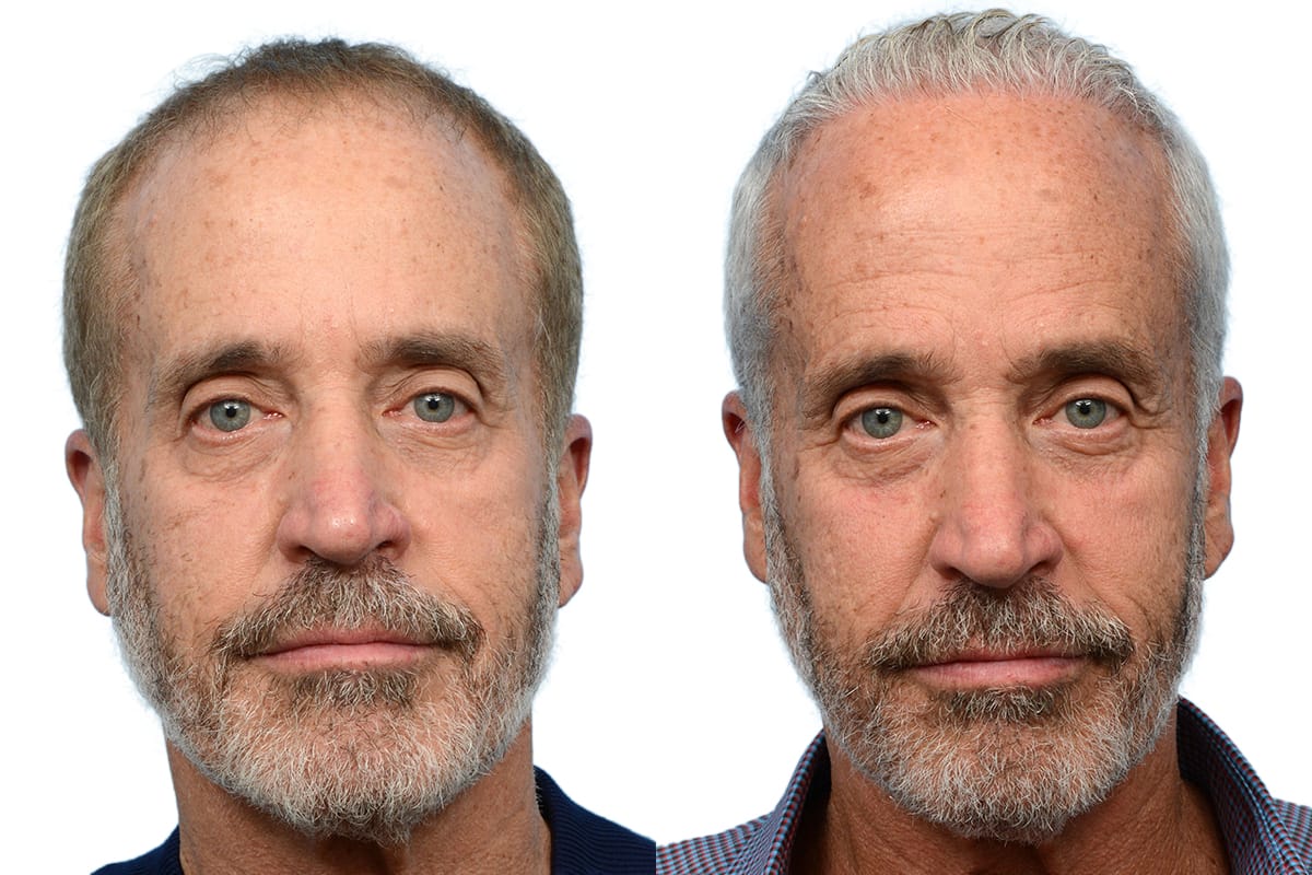 Hair Restoration  Before & After Gallery - Patient 263031 - Image 2
