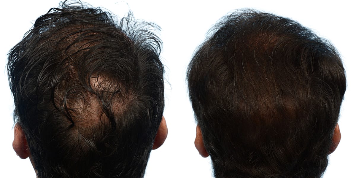 FUE Hair Transplant Before & After Gallery - Patient 408103 - Image 2