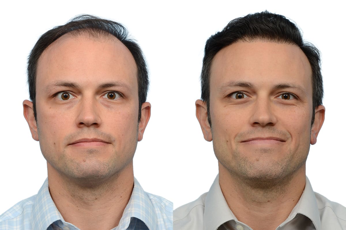 Hair Restoration  Before & After Gallery - Patient 405673 - Image 2
