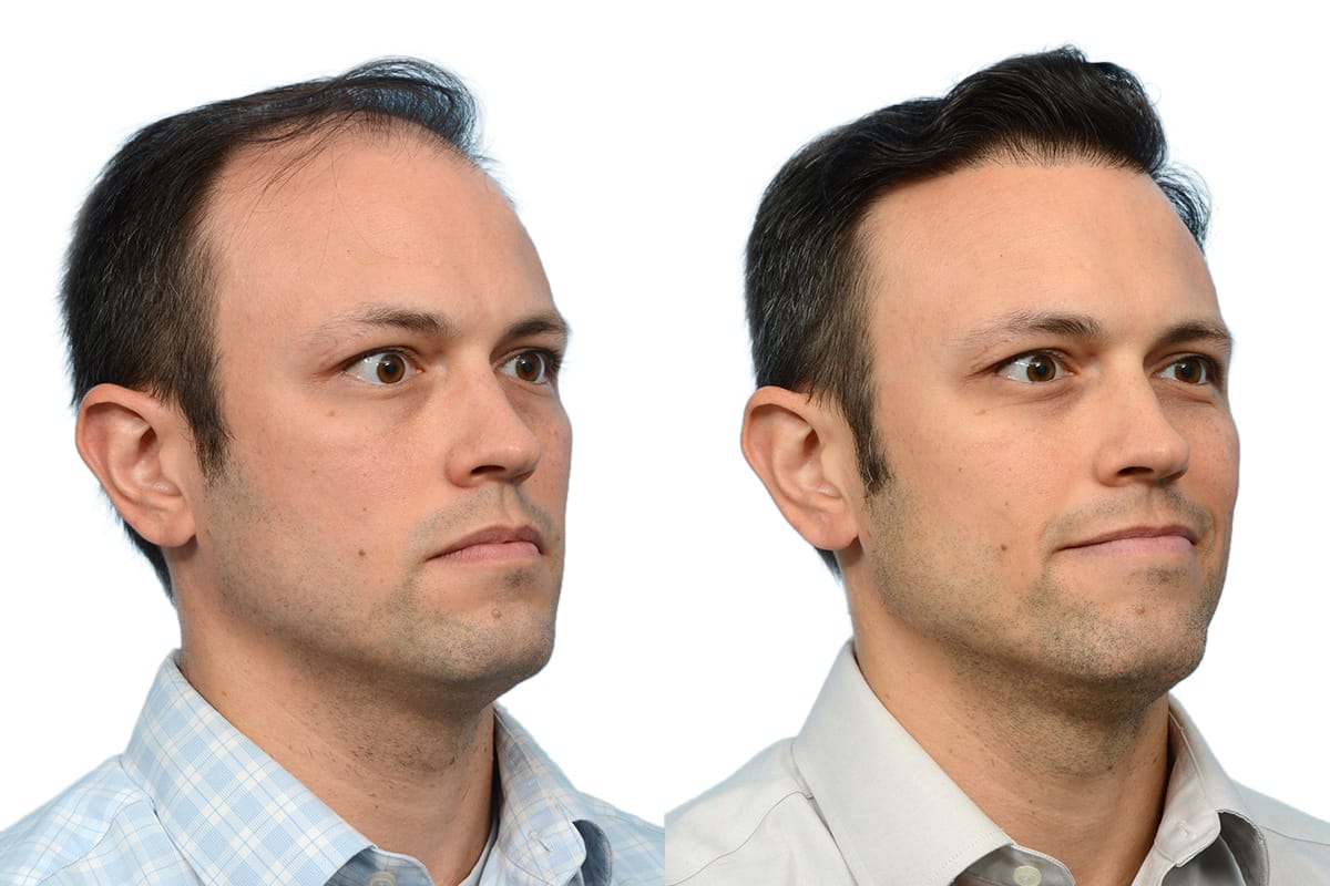 Hair Restoration  Before & After Gallery - Patient 405673 - Image 3