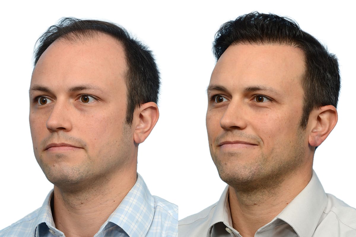 Hair Restoration  Before & After Gallery - Patient 405673 - Image 4