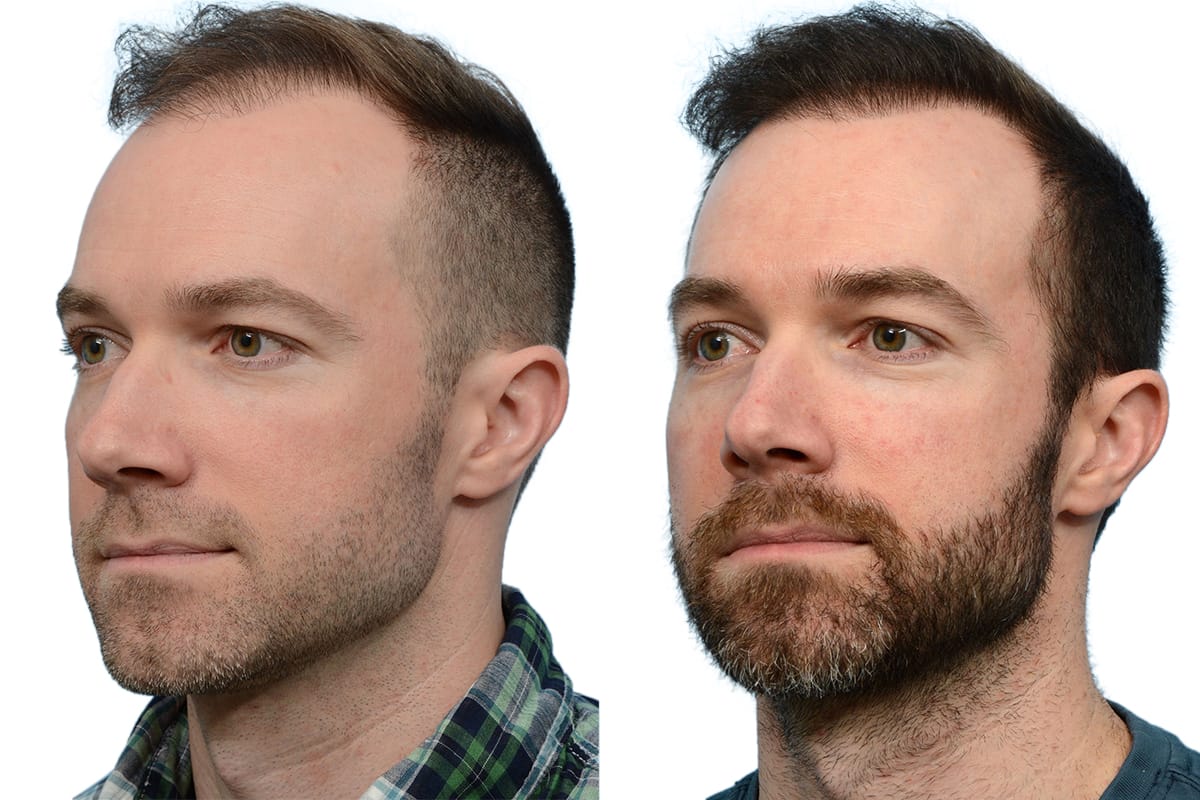Hair Restoration  Before & After Gallery - Patient 206856 - Image 2