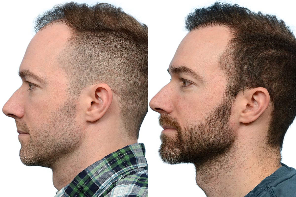 Hair Restoration  Before & After Gallery - Patient 206856 - Image 3