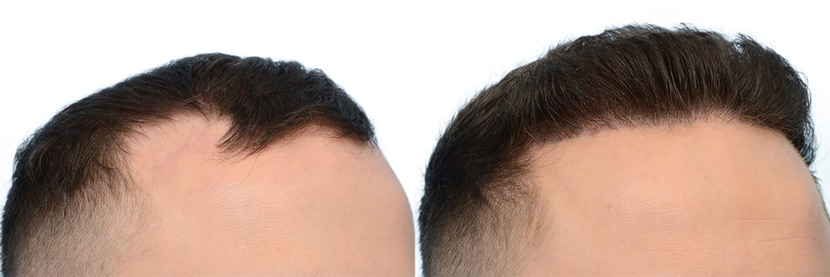 Hair Restoration  Before & After Gallery - Patient 246523 - Image 2