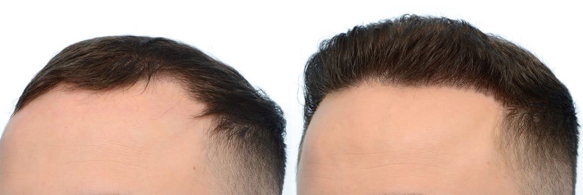 Hair Restoration  Before & After Gallery - Patient 246523 - Image 3