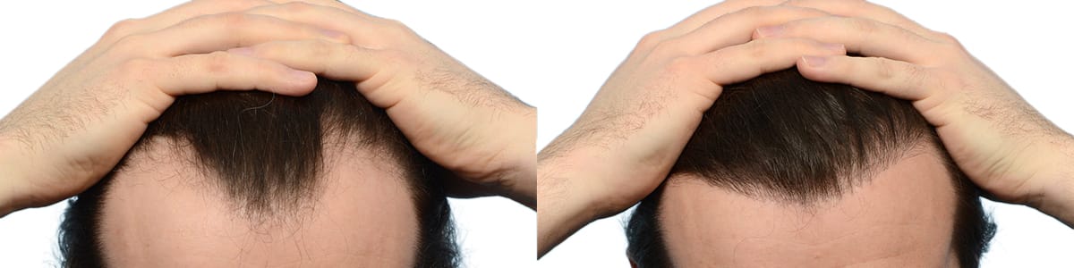 FUE Hair Transplant Before & After Gallery - Patient 250882 - Image 2