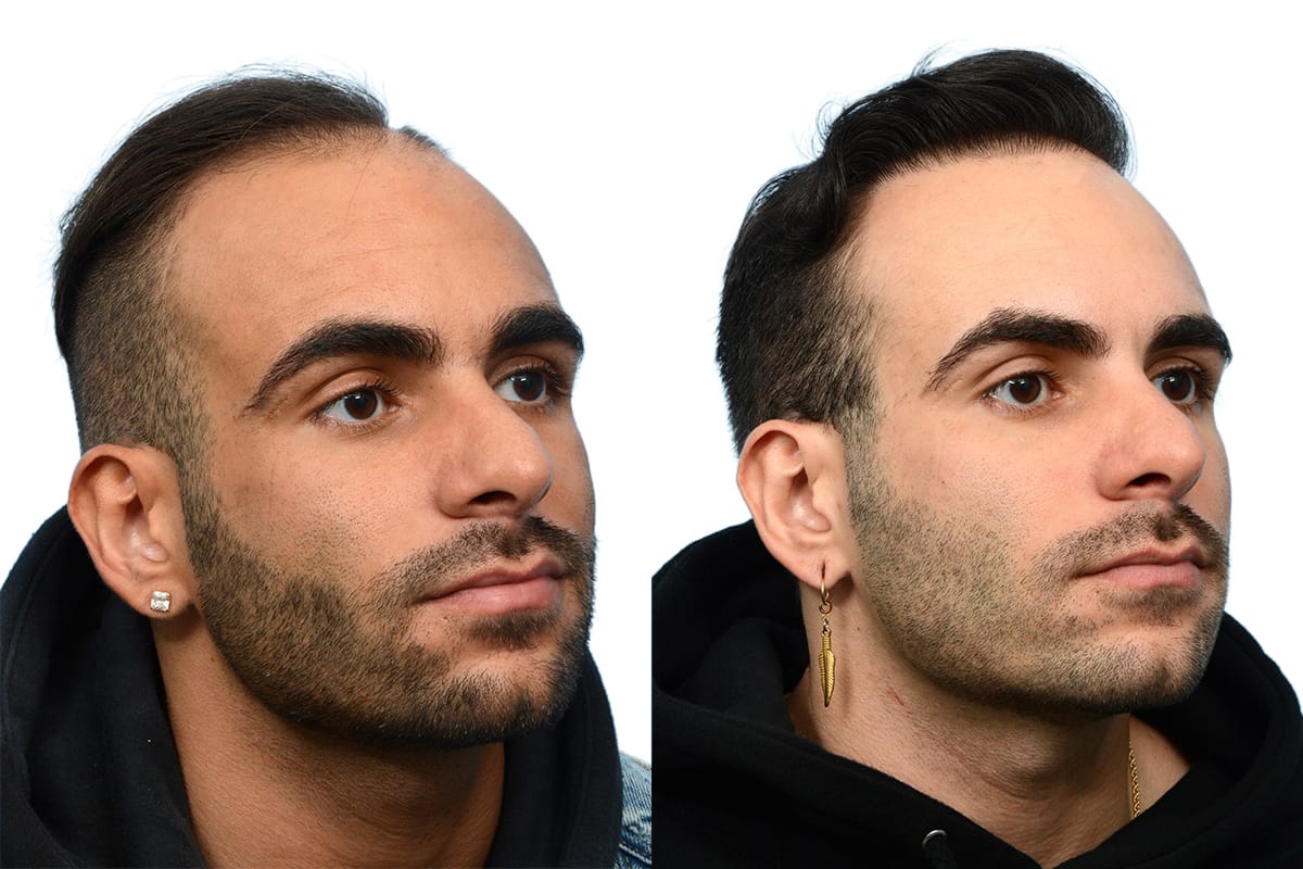 Hair Restoration  Before & After Gallery - Patient 412654 - Image 2