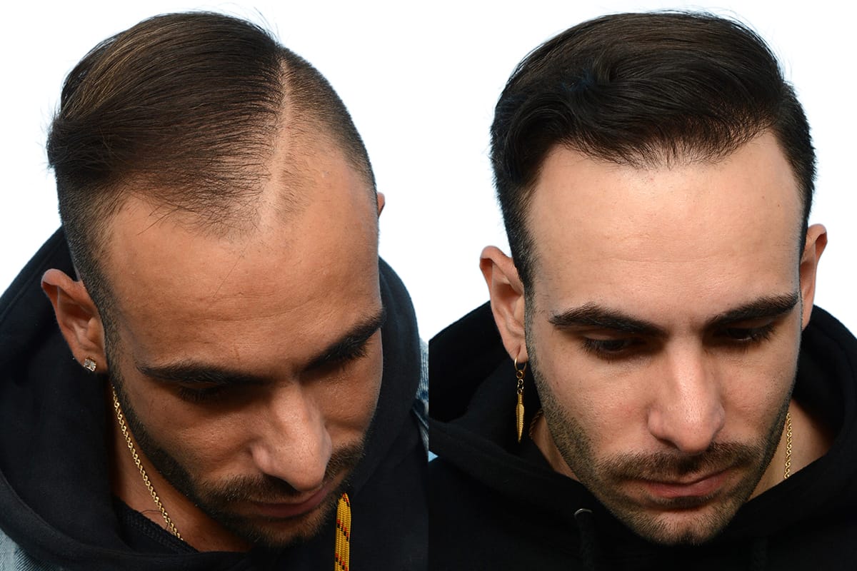 Hair Restoration  Before & After Gallery - Patient 412654 - Image 3