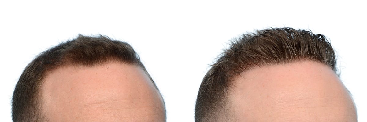 Hair Restoration  Before & After Gallery - Patient 427890 - Image 2