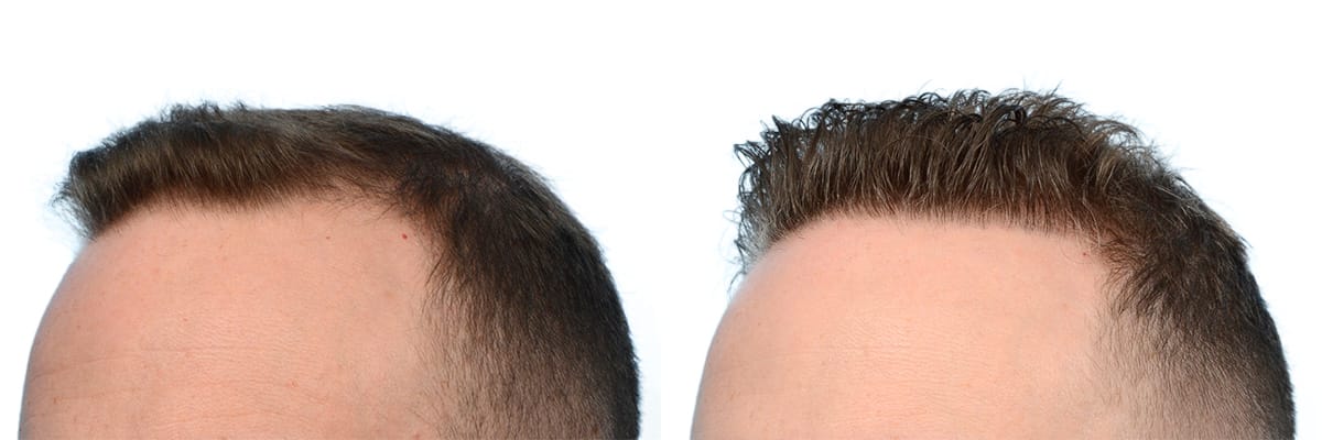 Hair Restoration  Before & After Gallery - Patient 427890 - Image 3