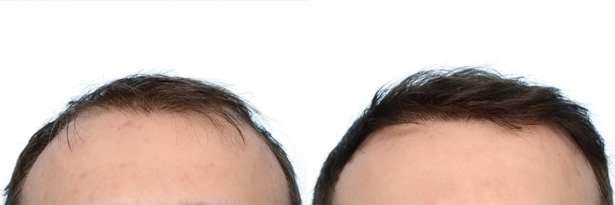 FUE Hair Transplant Before & After Gallery - Patient 360577 - Image 3