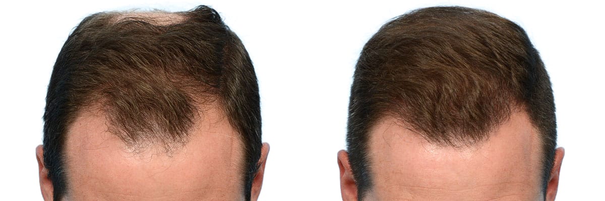 Hair Restoration  Before & After Gallery - Patient 400802 - Image 2