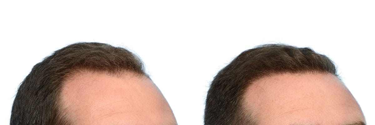 Hair Restoration  Before & After Gallery - Patient 400802 - Image 3