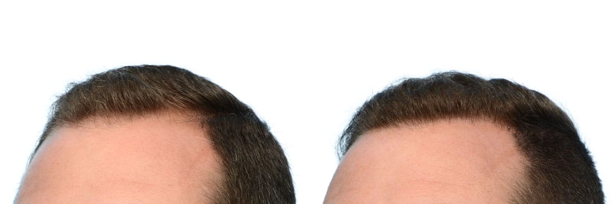 Hair Restoration  Before & After Gallery - Patient 400802 - Image 4