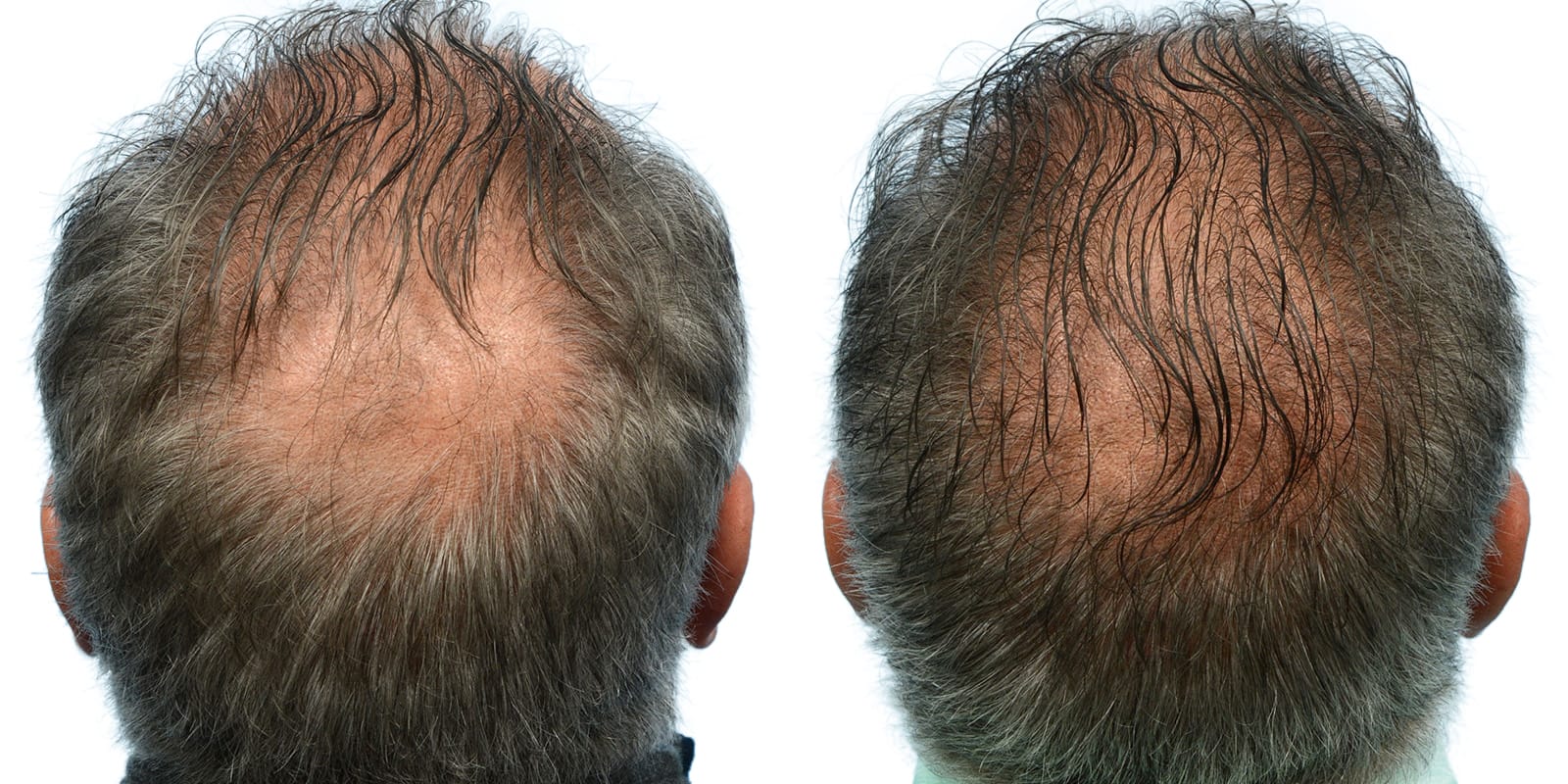 FUE Hair Transplant Before & After Gallery - Patient 865904 - Image 2