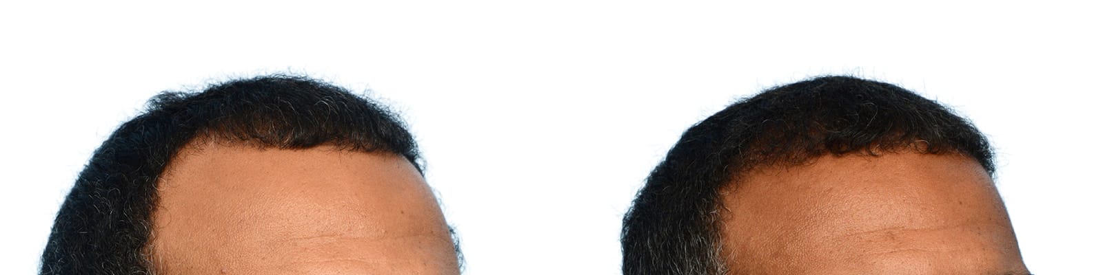 Hair Restoration  Before & After Gallery - Patient 264534 - Image 2