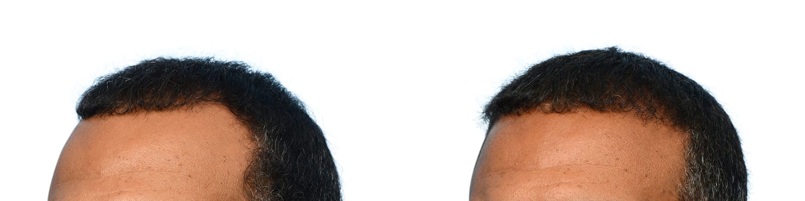 Hair Restoration  Before & After Gallery - Patient 264534 - Image 3