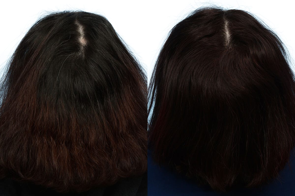 Hair Restoration  Before & After Gallery - Patient 261241 - Image 2
