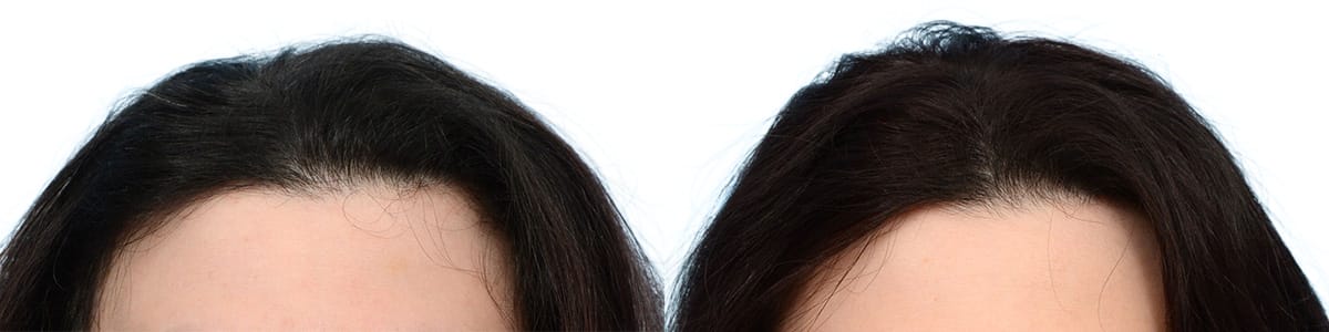 Hair Restoration  Before & After Gallery - Patient 261241 - Image 3