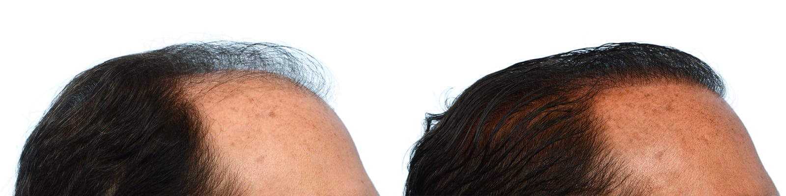 FUE Hair Transplant Before & After Gallery - Patient 176444 - Image 2