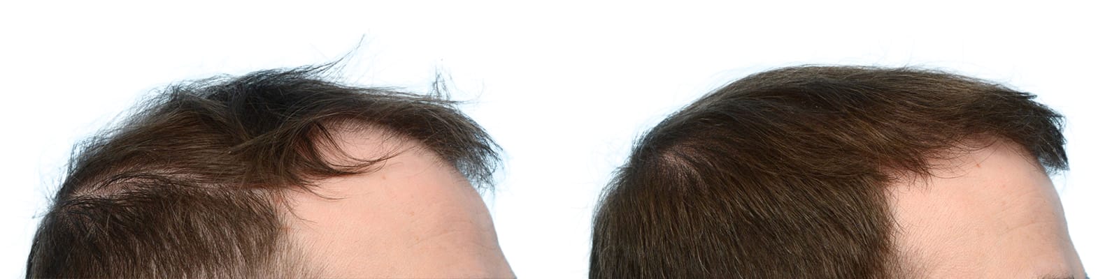 FUE Hair Transplant Before & After Gallery - Patient 308292 - Image 3
