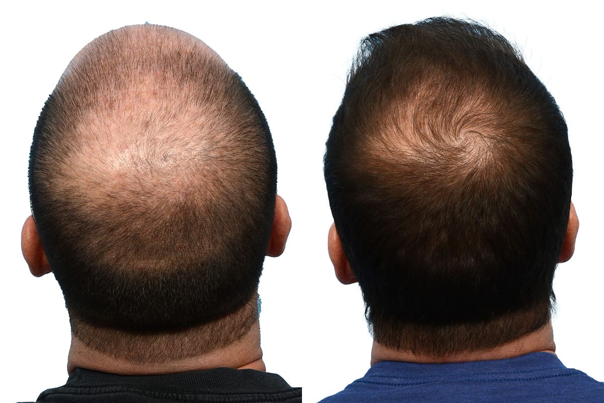 FUE Hair Transplant Before & After Gallery - Patient 906332 - Image 4