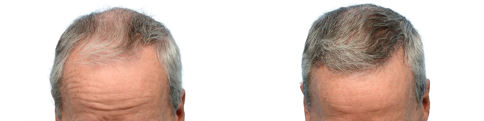 Hair Restoration  Before & After Gallery - Patient 338999 - Image 2